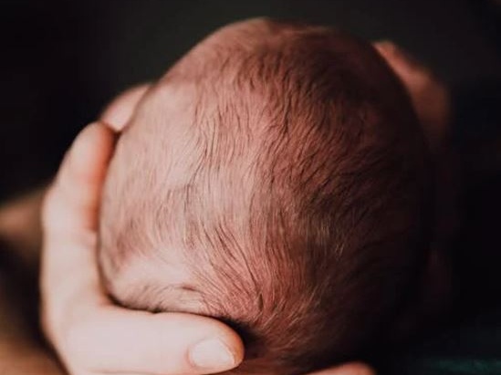 Studio: i padri di 11 bimbi affetti dalla 'sindrome del lupo mannaro' avevano usato lozioni anti-calvizie